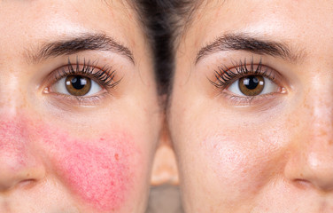 Before and after successful rosacea treatment on the face of a caucasian lady. Redness and visible...