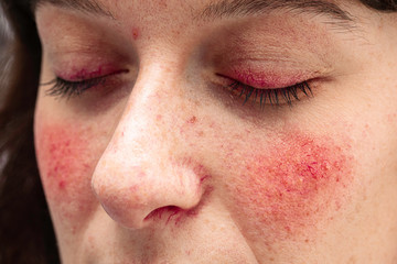 A close up view on the face of a young caucasian lady, suffering from a severe case of rosacea, with facial redness and dilated blood vessels of the eyelids, nose and cheeks.