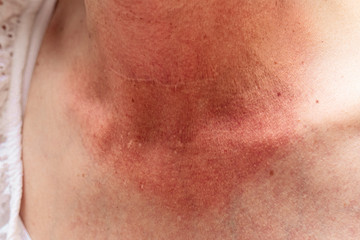 Fototapeta premium A closeup view on the sunburned skin of a caucasian lady with visible tan line around the neck and upper chest area, unprotected from UV damage with painful redness.