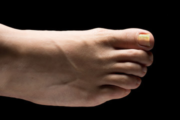 Fototapeta premium A close up and top view of a bare caucasian human foot, isolated against a black background, yellow and thickened toenails are seen in detail, symptomatic of tinea unguium, a fungal infection.