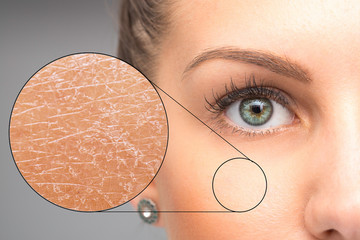 A magnified macro detailed circle is seen over the cheek of a beautiful caucasian girl, closer inspection of the skin shows dry and flaky skin, in need of dermatologist.