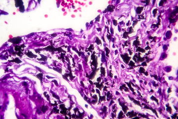 Histopathology of smoker's lung. Light micrograph showing accumulation of carbon particles in lung tissue
