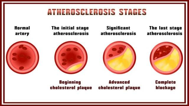 Atherosclerosis. Disturbance of lipid and protein metabolism, adjournment the cholesterol plaques in arteries.