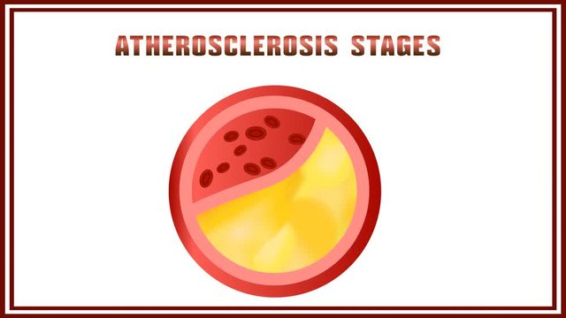 Atherosclerosis. Disturbance of lipid and protein metabolism, adjournment the cholesterol plaques in arteries.