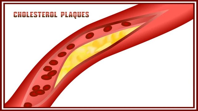 Atherosclerosis. Disturbance of lipid and protein metabolism, adjournment the cholesterol plaques in arteries.