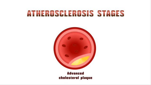 Atherosclerosis. Disturbance of lipid and protein metabolism, adjournment the cholesterol plaques in arteries.