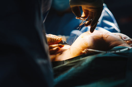Plastic surgeon sewing up breast of female patient after inserting implants in operating room