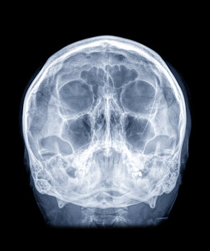  Skull x-ray image of Human skull  water view for demonstrate facial bone isolated on Black Background.