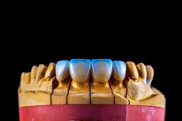 4 units natural color press ceramic veneers