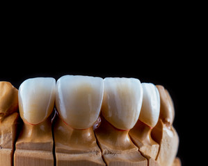 4 units natural color press ceramic veneers