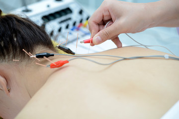 Electro-Acupuncture.Traditional Chinese acupuncture and Electroacupuncture on body of patient - obrazy, fototapety, plakaty