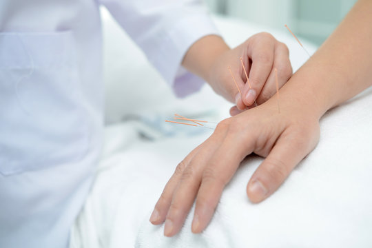 Closeup of hand performing acupuncture therapy on patient's back at chinese alternative medicine clinic