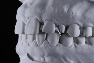 dental cast