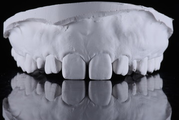 dental cast