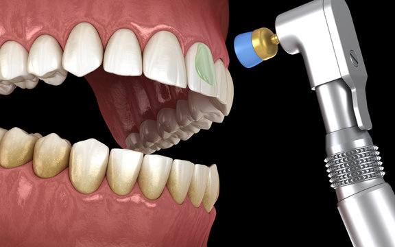 Teeth polishing procedure with professional brush and gel. Medically accurate 3D illustration