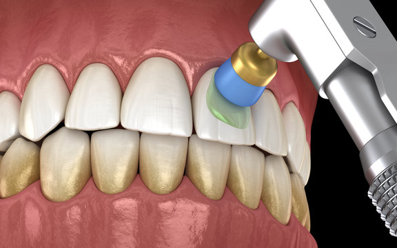 Teeth polishing procedure with professional brush and gel. Medically accurate 3D illustration
