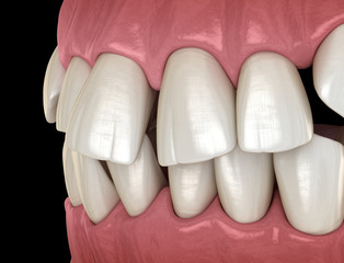 Abnormal teeth position, orthodontic concept. Medically accurate tooth 3D illustration