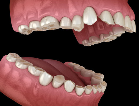 Как выглядит стираемость зубов Tooth Erosion Изображения: просматривайте стоковые фотографии, векторные изображ