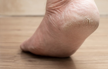 Closed-up of cracked heels, also known as fissures, a common foot problem