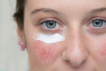 A closeup view of a pretty caucasian girl with topical cream below the eye, over red blotchy cheek,...