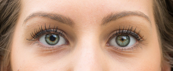 A closeup view on the green eyes of a pretty caucasian girl with one pupil larger than the other. A...
