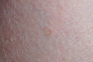Basal cell carcinoma, benign skin cancer, basal-cell cancer on human skin, keratinizing squamous cell carcinoma of the skin. no healthy epidermis. cancer at the beginning 