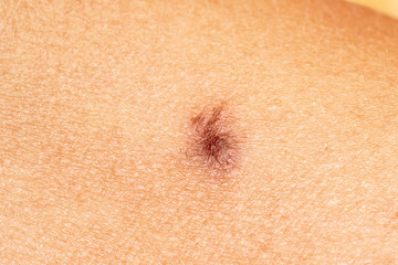 A closeup view on a brown mole on the skin of a human, with uneven jagged edges and scabbing, warning signs of skin cancer on person.
