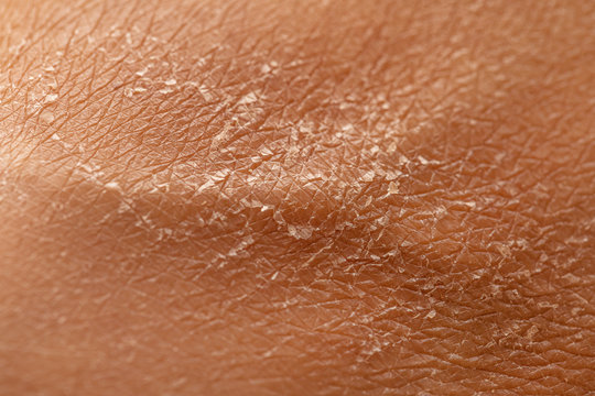 An extreme closeup and detailed macro view of caucasian skin filling the frame, dried out and flaking due to lack of moisturizer, in need of dermatologist.