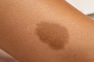 A closeup view of a large brown birthmark on the leg of a person, normally harmless and benign skin pigmentation can cause anxiety of appearance. - obrazy, fototapety, plakaty