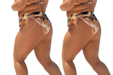 Before and after successful laser removal surgery on cellulite of a mature woman wearing a colorful...