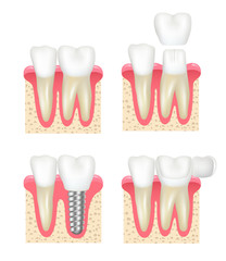 Dental crown. Tooth veneer implants healthy cavity stomatology dentist vector collection. Medical implant, dental crown for tooth illustration