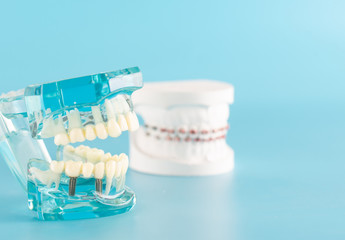 Fototapeta na wymiar Dental implant model on blue background.