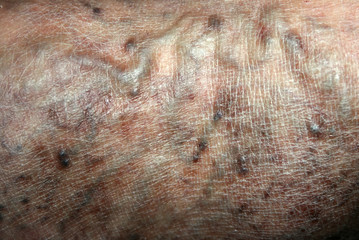 Varicose veins. Phlebeurysm. Thrombophlebitis. leg in veins