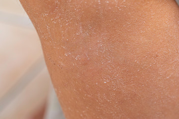 An extreme close up view if dry and shedding caucasian skin, dead and peeling away from the human...