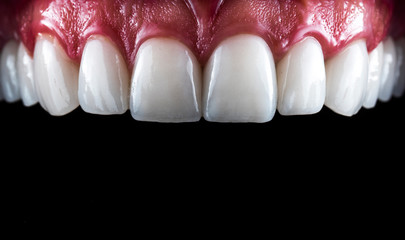 full mought recovery by press ceramic veneers