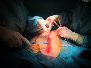 Laparotomy the process of peritoneal incision. Operating room undergoing surgery. Health care and...
