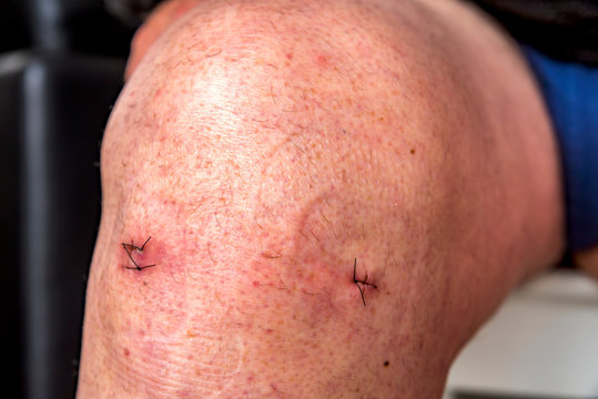 Points de suture sur un genou