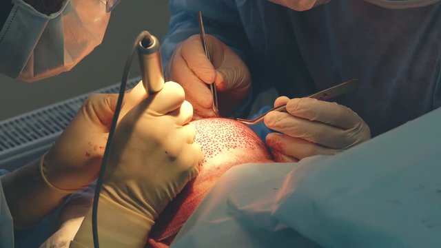 Baldness treatment. Hair transplant. Surgeons in the operating room carry out hair transplant surgery. Surgical technique that moves hair follicles from a part of the head.