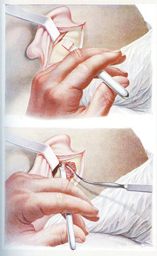 Surgery and medicine - trepanation of the mastoid process, the bony prominence behind the earlobe