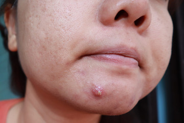 Woman squeezing pimple with dirty bare hands, Removing pustules whitehead acne from face, Problems...