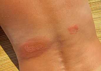 Damaged jellyfish body parts © Rostyslav