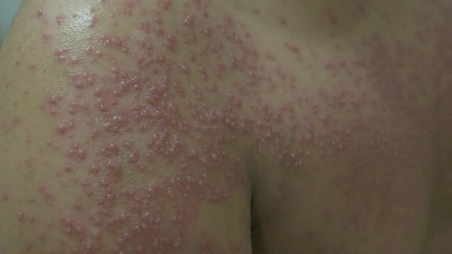 Tenggarong, Indonesia, 2019 July 29th, Close up of patient who is having varicella or chickenpox disease in hospital