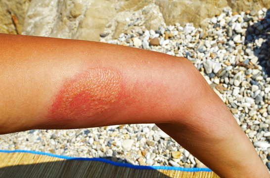 Female hand is struck by jellyfish