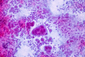 View in microscopic of abnormal human cells.Non gynae specimen from smear slide.Cytology and pathology laboratory department.Magnification 400X