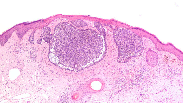 Skin biopsy pathology of basal cell carcinoma, the most most common type of sun induced skin cancer, invading the dermis.  Regular use of sunscreen can be preventative.