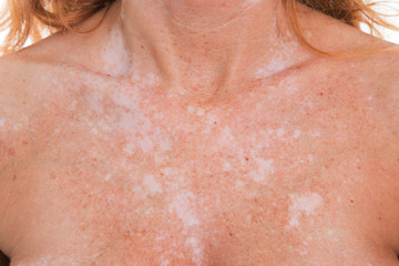 detail of vitiligo spots on the skin
