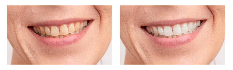 Teeth whitening. Close up of female mouth.