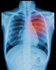 X-ray image of chest, heart, chest pain