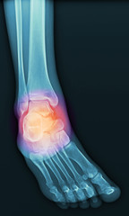  X-ray images of ankle pain