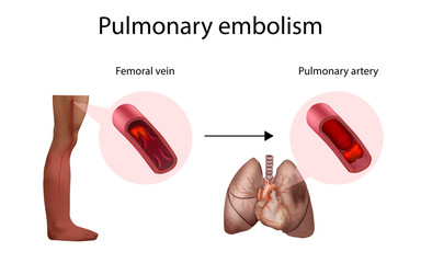 Pulmonary embolism, deep vein thrombosis. Vector medical anatomy illustration.